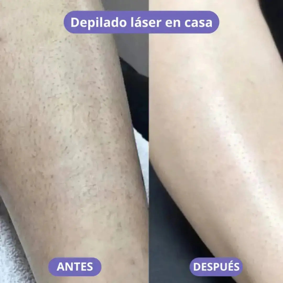 LisseLáser™ - Dile Adiós a los Vellos Indeseados 🌸