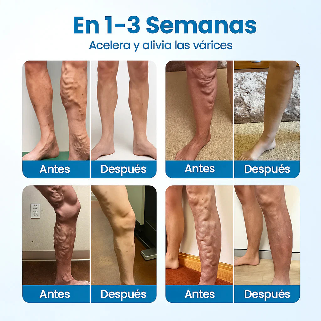 VarixFree™ – Piernas bonitas, firmes y saludables ✨