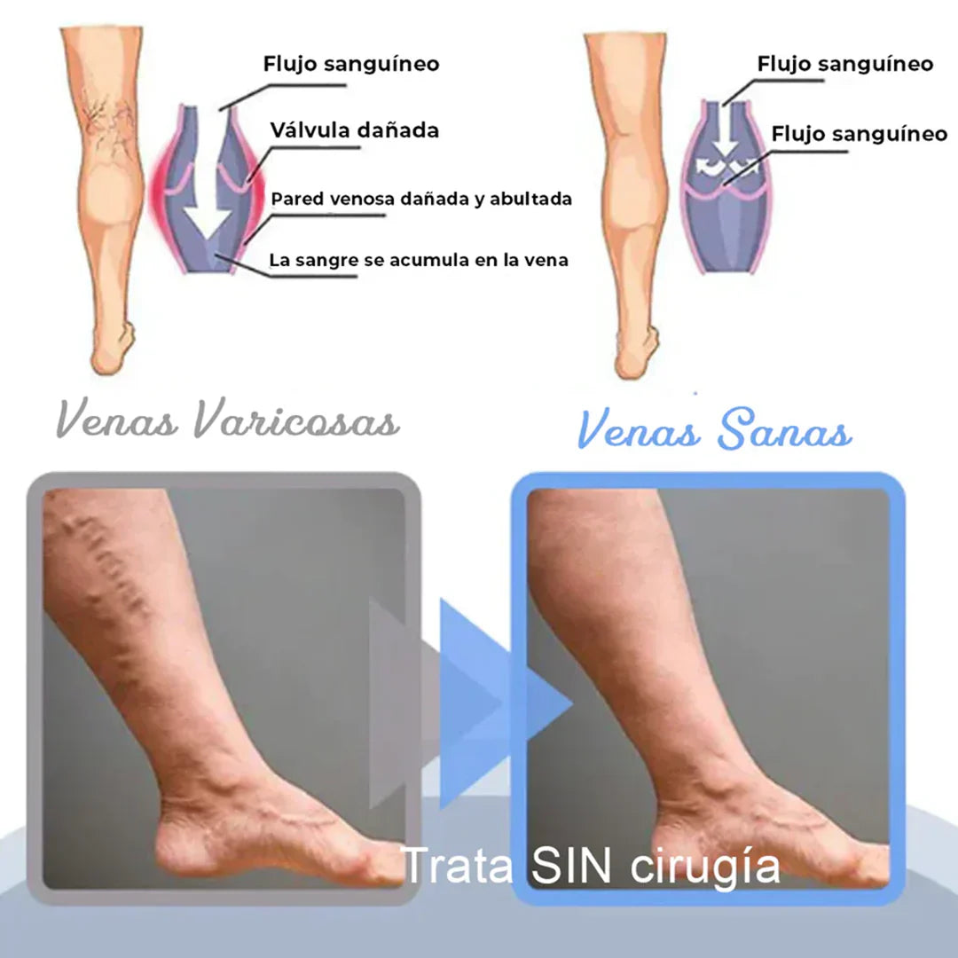 VarixFree™ – Piernas bonitas, firmes y saludables ✨