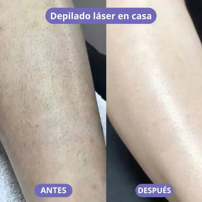 LisseLáser™ - Dile Adiós a los Vellos Indeseados 🌸