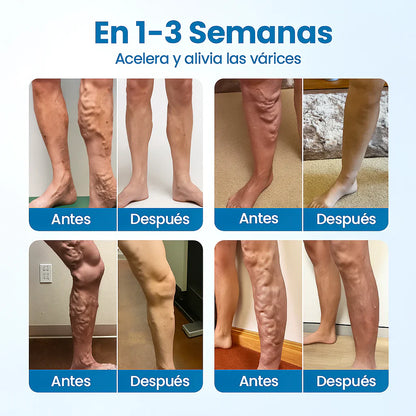 VarixFree™  – Piernas bonitas, firmes y saludables ✨